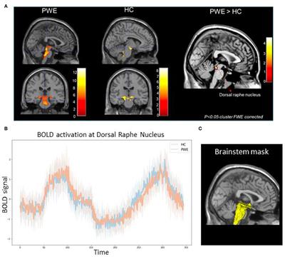 Functional MRI Correlates of Carbon Dioxide Chemosensing in Persons With Epilepsy